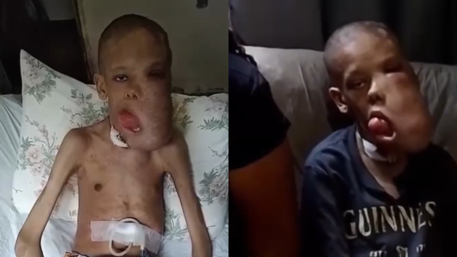 Erick luta todos os dias apenas para conseguir suportar o peso causado pelos tumores.